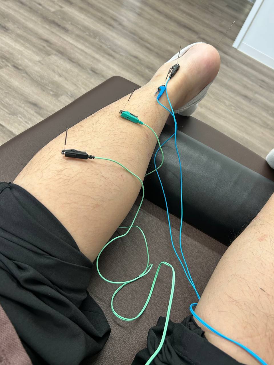 鍼灸によるコンディショニング施術